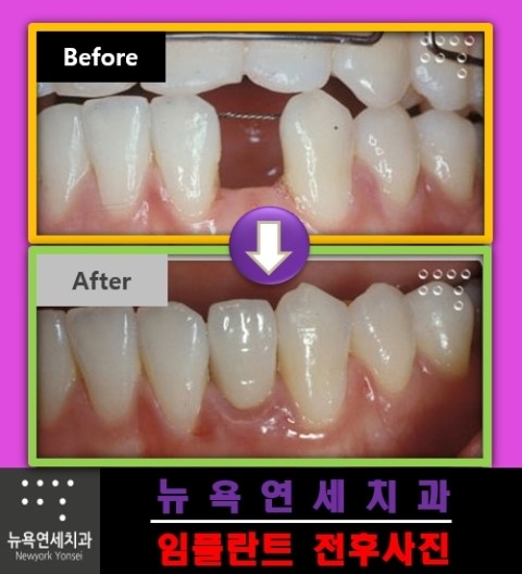  ##앞니임플란트,심미임플란트,앞니임플란트수술,앞니임플란트가격##