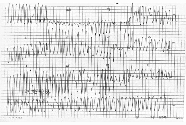 Atrial Fibrillation & Atrial Flutter in WPW : 네이버 블로그