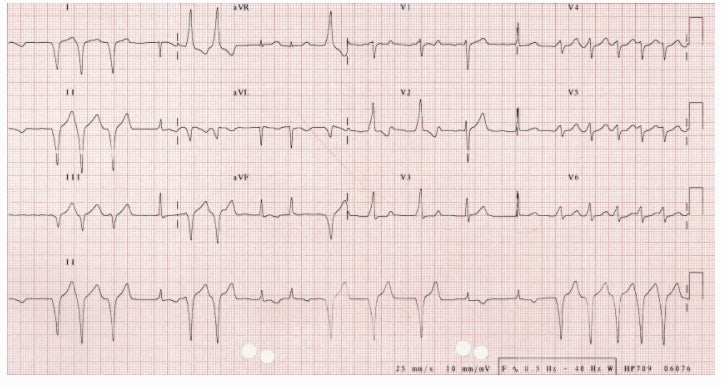 Atrial Fibrillation & Atrial Flutter in WPW : 네이버 블로그