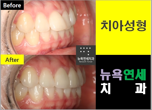  ##치아성형기간,라미네이트기간,올세라믹기간,앞니성형전후##