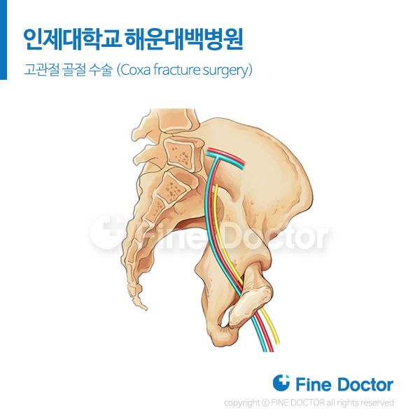 메디컬일러스트 고관절 골절 수술 (Coxa fracture surgery)