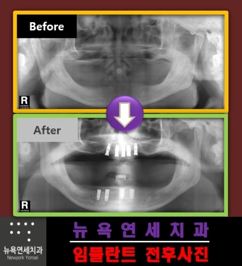  임플란트제품,임플란트종류,임플란트병원추천,임플란트치료방법
