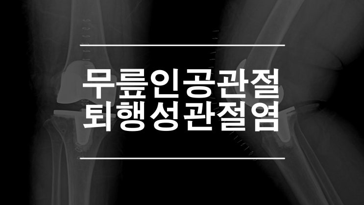  무릎인공관절 퇴행성관절염의 치료 방법 / 제이본정형외과 권제호