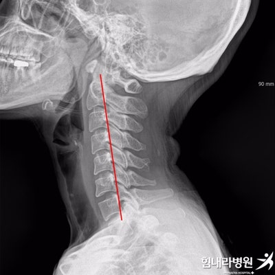 부산아이잠치료병원 경추추간판 탈출증 초기증상