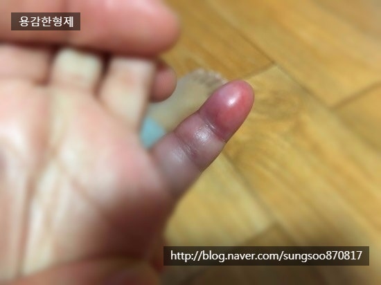 손톱멍 민간요법 : 네이버 블로그 손톱멍 민간요법 : 네이버 블로그