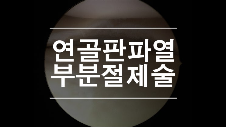  연골판파열 부분절제술 수평으로 찢어진 반달연골