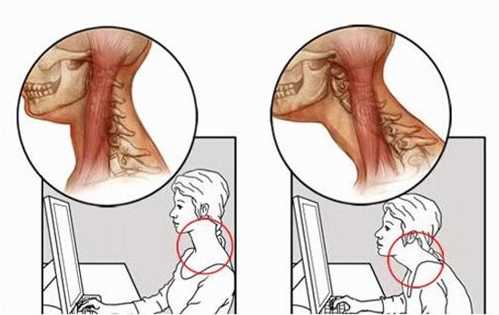 뒷목이 뻐근한 증상 - 뒷목통증원인과 질환들 : 네이버 블로그 뒷목이 뻐근한 증상 - 뒷목통증원인과 질환들 : 네이버 블로그