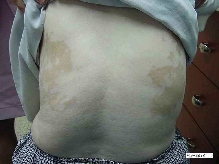 제16장. 백반증(白斑症, Vitiligo) [요약][진단][치료] - 한국에... 