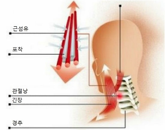 뒷목이 뻐근한 증상 - 뒷목통증원인과 질환들 : 네이버 블로그 뒷목이 뻐근한 증상 - 뒷목통증원인과 질환들 : 네이버 블로그