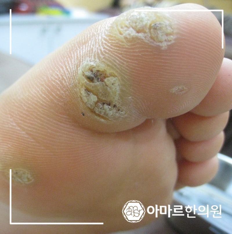 발바닥 사마귀 제거 치료 후 재발 2