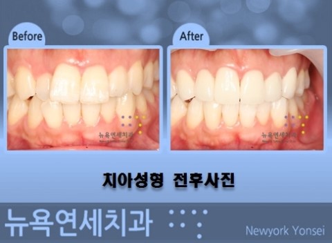  치아성형앞니,치아성형잘하는곳,치아성형병원,앞니치아성형시술