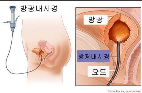 방광내시경은 언제 하는가?