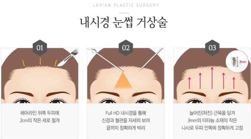 이마거상술후기 6년 넘은 8