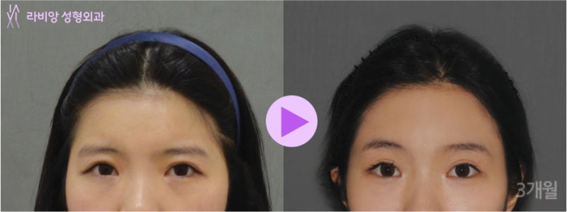 이마거상술후기 6년 넘은 2