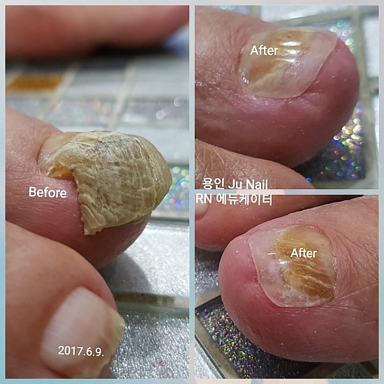 아빠와 딸/분당용인수원수지보정죽전동/주네일/파고드는발톱 아빠와 딸/분당용인수원수지보정죽전동/주네일/파고드는발톱