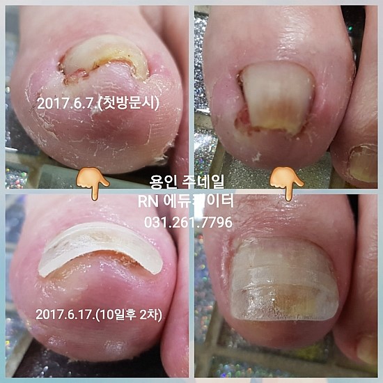 10일의변화/분당용인수원수지보정죽전동/주네일/파고드는발톱 10일의변화/분당용인수원수지보정죽전동/주네일/파고드는발톱