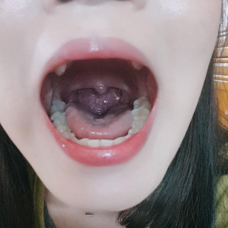 편도선 수술 후기 : 3개월 경과 후 비교 사진