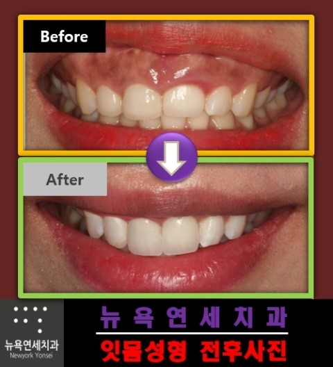  ##잇몸성형병원,잇몸성형비,잇몸성형치과,잇몸수술가격@@