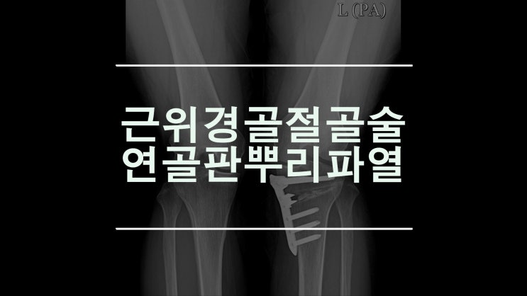  근위경골절골술 연골판뿌리파열 에 대한 또 하나의 치료법
