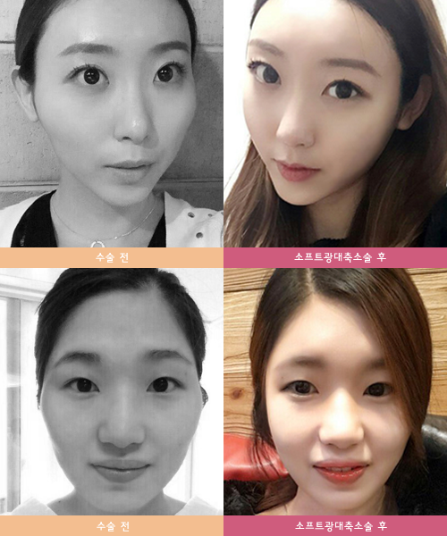 광대축소술을 찾으신다면 1
