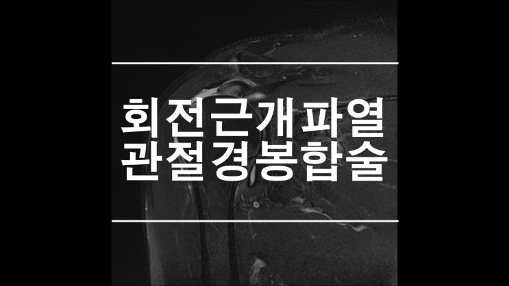  회전근개파열 관절경 이중봉합술로 더욱 단단하게
