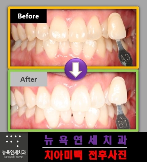 치과에서 스탠다드 치아미백으로 미백 치료를 받은 전후 사례입니다.
