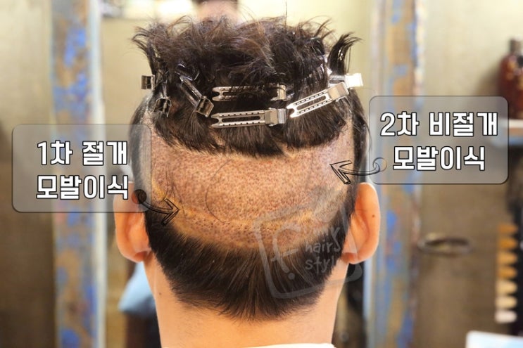  루트의원 2차 비절개 남자 모발이식 후 퍼니M 스티커 테이프 붙임머리