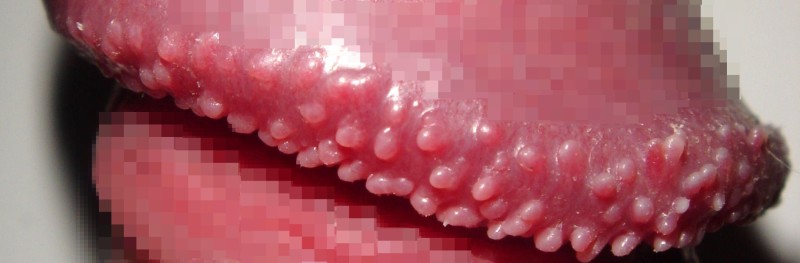 진주양구진] 귀두 줄레에 좁쌀같은거 [부산비뇨기과] : 네이버 블로그
