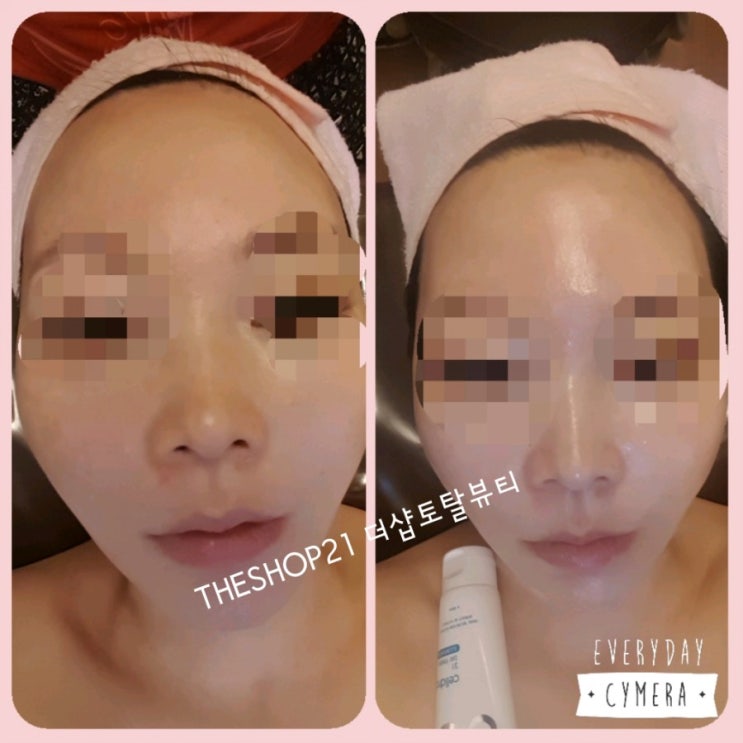  메디컬스킨케어 캐치필 관리(마포메디컬스킨케어 자극없는필링)