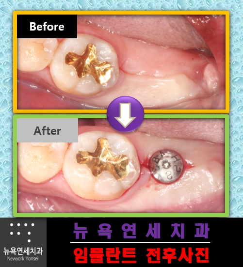  ##임플란트기간,임플란트방법,임플란트비용,임플란트추천병원##