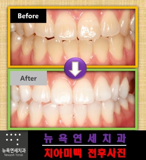  치과치아미백,치과미백,미백치과추천,치아미백잘하는법