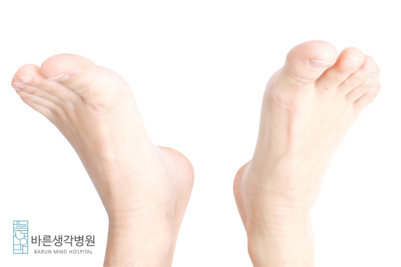 대전 족저근막염 발바닥 색으로 구별하는 방법 9