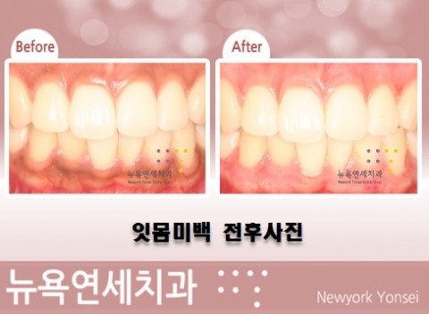  잇몸미백 전후 사진을 통해서 어느 정도 효과가 있는지 알아 보겠습니다.