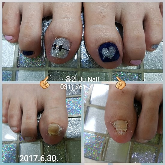 잃어버린발톱/분당용인수원수지보정죽전동/주네일/파고드는발톱 잃어버린발톱/분당용인수원수지보정죽전동/주네일/파고드는발톱