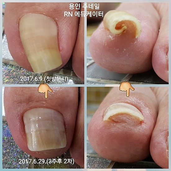 아빠와딸 3주후의놀라움/분당용인수원수지보정죽전동/주네일/파고드는발톱 아빠와딸 3주후의놀라움/분당용인수원수지보정죽전동/주네일/파고드는발톱