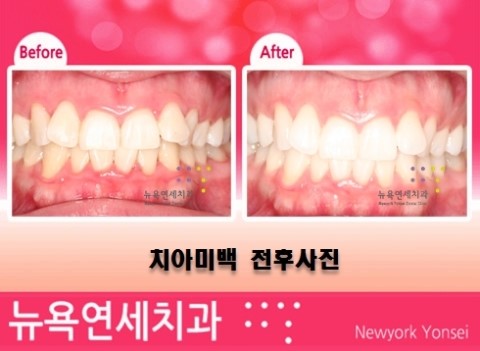 치과에서 받는 전문가 치아미백 중 원데이치아미백 전후 사례를 알아 봅니다