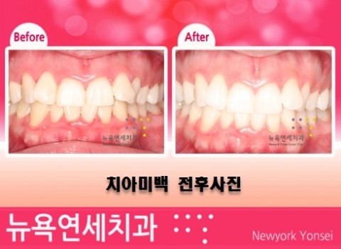  치과에서 받는 전문가 치아미백 중 원데이치아미백 전후 사례를 알아 봅니다