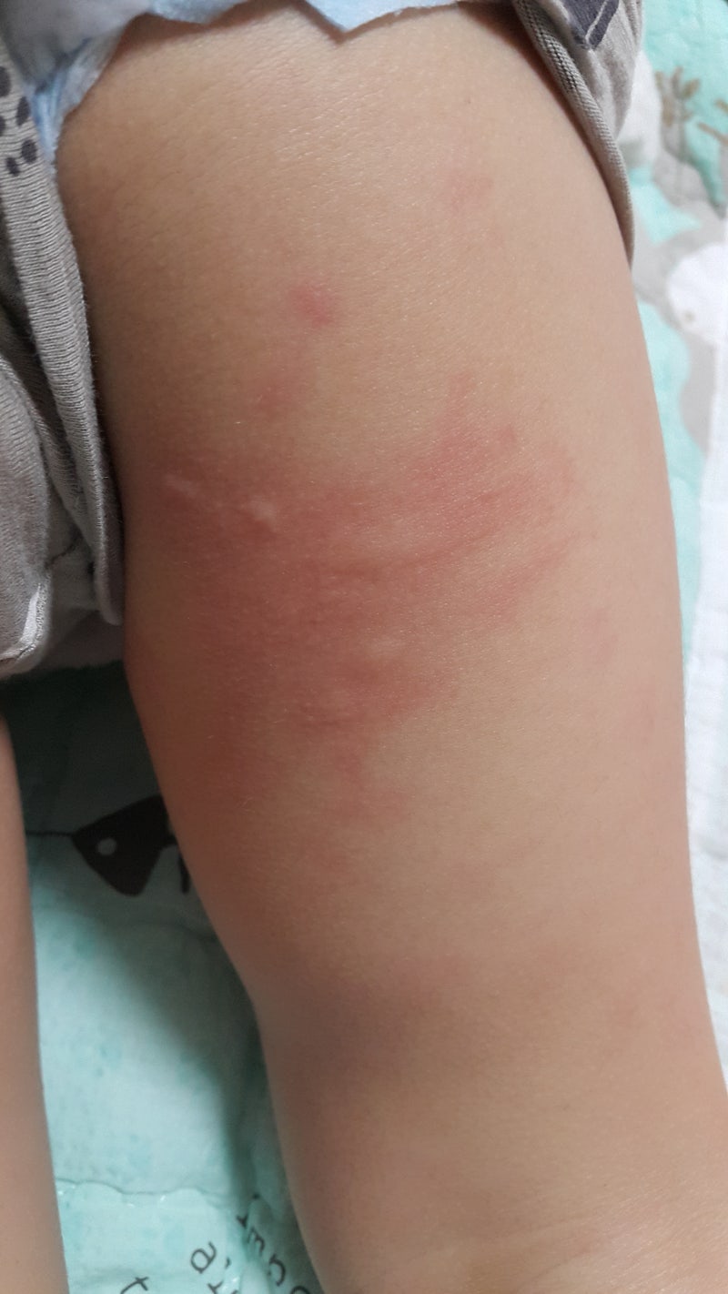 아기발진, 내 아이 몸 두드러기의