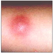 종기(농양), 프릉클(뾰루지/깊은 농포), 모낭염, 종창 Abscess, Furuncles, Folliculitis ...