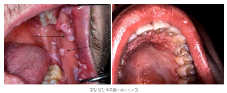  [논문] HIV 음성 MSM과 HIV에 감염된 MSM의 인간 유두종바이러스 구강 감염((MSM: ‘남자와 성관계를 갖는 남자들’의 의학적인 약자)