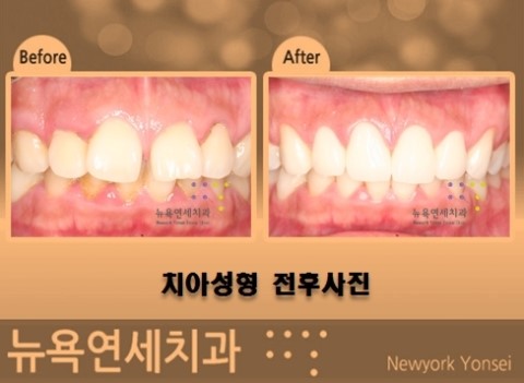  [치아성형 전후 사진] 앞니가 벌어진 상태를 앞니성형 한 케이스