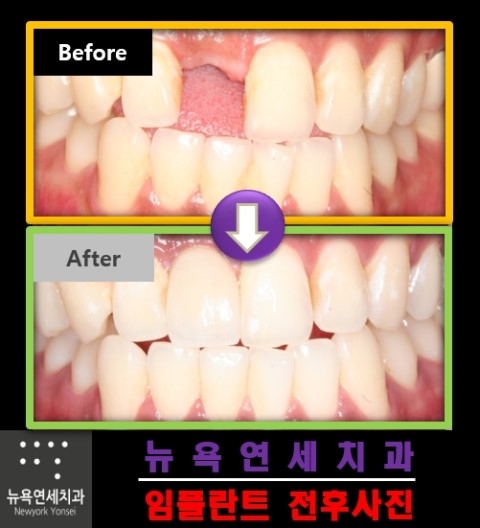  임플란트로 치료를 한 앞니 임플란트 시술 전후 사례 정리