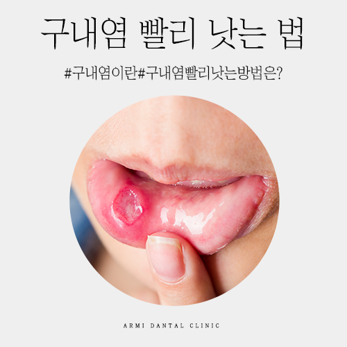 구내염의 원인과 빨리 낫는 방법을 알아보세요! 4