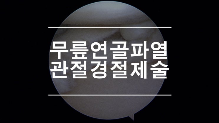  무릎연골판파열 퇴행성으로 인한 수평 파열에 대한 부분 절제술 A/S Meniscectomy