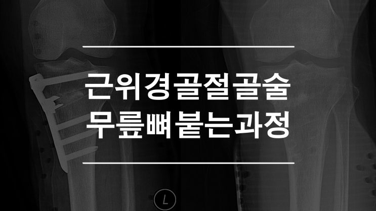  근위 경골 절골술 뼈 붙는 과정 2년의 결과 (Osteotomy Union)