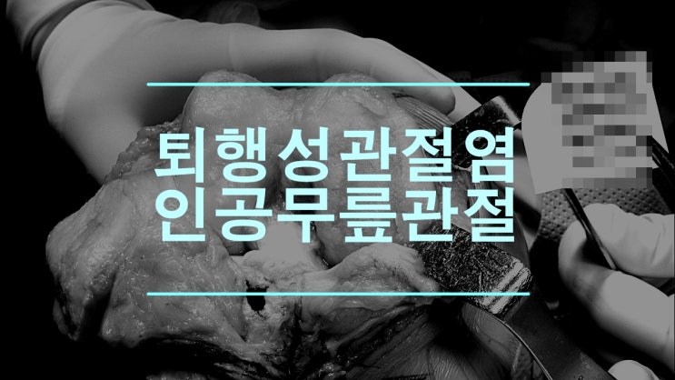  무릎인공관절 전치환술 백두산을 위한 길