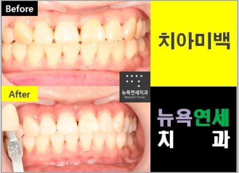  하얀 치아를 만드는 방법으로 스피드업 치아미백 전후 사진을 정리합니다