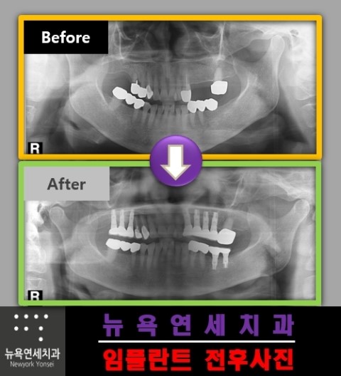 임플란트 수술로 자연치아를 대체 하는 가장 좋은 치료 방법!