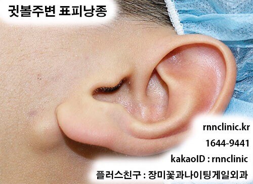 Rnn클리닉] 귀, 귓볼, 귀주변 표피낭종, 피지낭종 치료 - 핀홀법 : 네이버 블로그