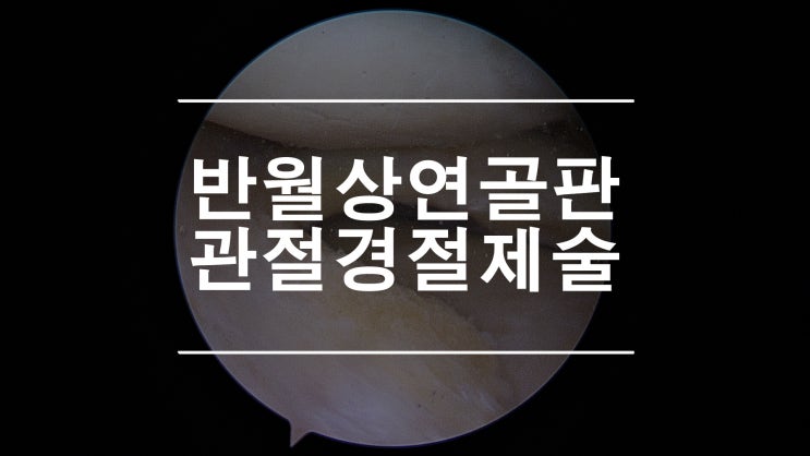  무릎연골찢어짐 관절경을 이용한 부분 절제술 Arthroscopic meniscectomy by 제이본정형외과 권제호